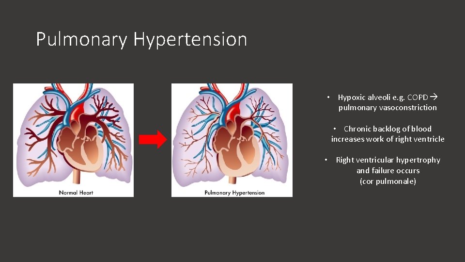 Pulmonary Hypertension • Hypoxic alveoli e. g. COPD pulmonary vasoconstriction • Chronic backlog of