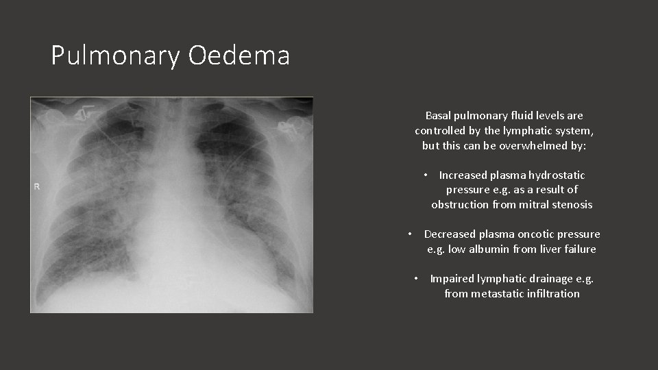 Pulmonary Oedema Basal pulmonary fluid levels are controlled by the lymphatic system, but this