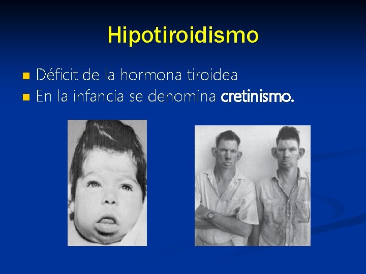 Hipotiroidismo n n Déficit de la hormona tiroidea En la infancia se denomina cretinismo.