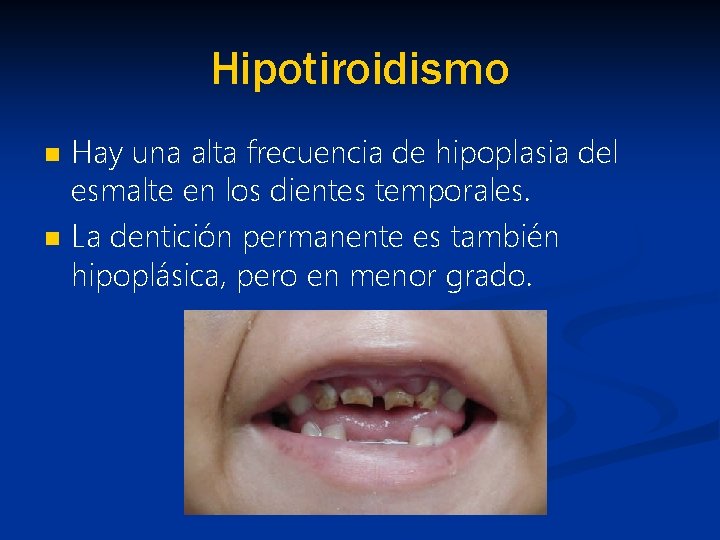 Hipotiroidismo n n Hay una alta frecuencia de hipoplasia del esmalte en los dientes