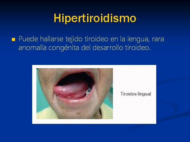 Hipertiroidismo n Puede hallarse tejido tiroideo en la lengua, rara anomalía congénita del desarrollo