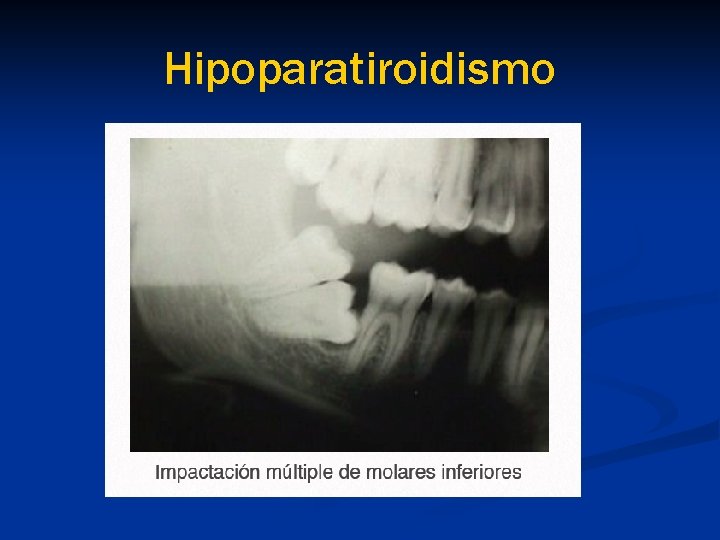 Hipoparatiroidismo 