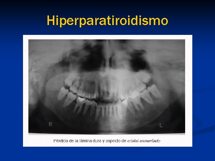 Hiperparatiroidismo 