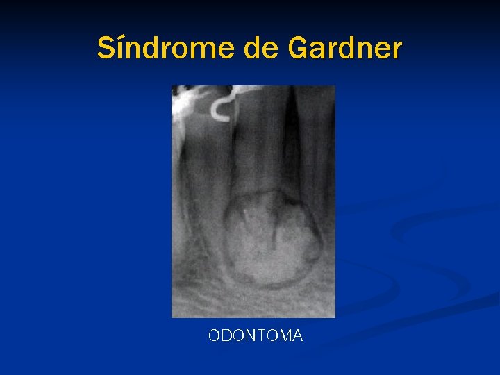 Síndrome de Gardner ODONTOMA 