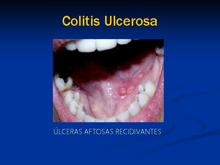 Colitis Ulcerosa ÚLCERAS AFTOSAS RECIDIVANTES 