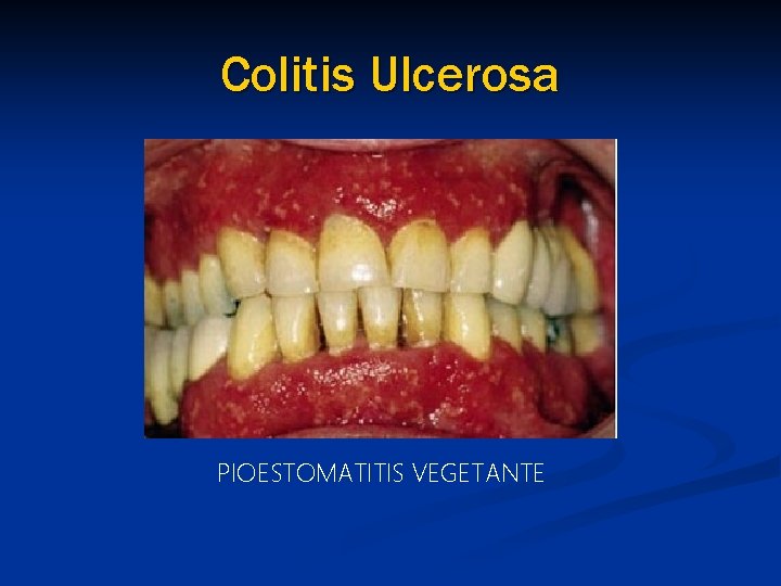 Colitis Ulcerosa PIOESTOMATITIS VEGETANTE 