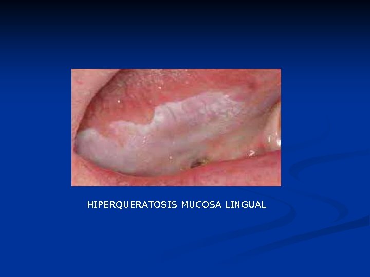 HIPERQUERATOSIS MUCOSA LINGUAL 