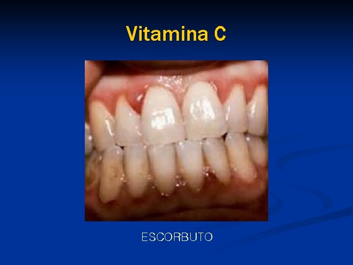 Vitamina C ESCORBUTO 