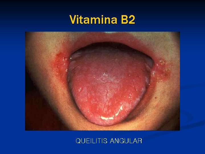 Vitamina B 2 QUEILITIS ANGULAR 