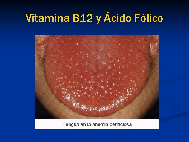 Vitamina B 12 y Ácido Fólico 