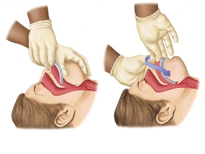 Insert oropharyngeal airway with tip facing palate. • Insert oropharyngeal airway with tip facing