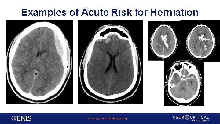 Examples of Acute Risk for Herniation 