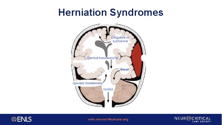 Herniation Syndromes 