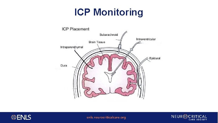 ICP Monitoring 