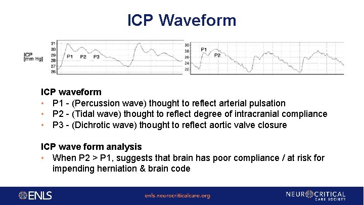 ICP Waveform ICP waveform • P 1 - (Percussion wave) thought to reflect arterial