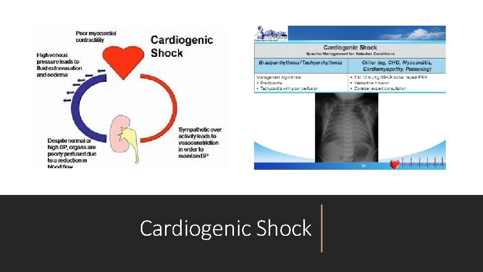 Cardiogenic Shock 