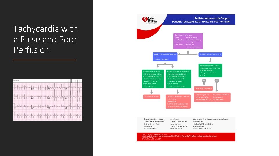 Tachycardia with a Pulse and Poor Perfusion 