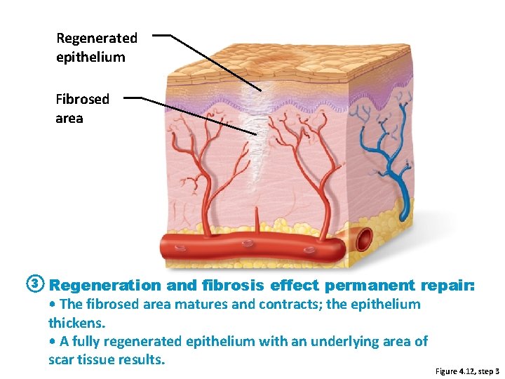 Regenerated epithelium Fibrosed area 3 Regeneration and fibrosis effect permanent repair: • The fibrosed