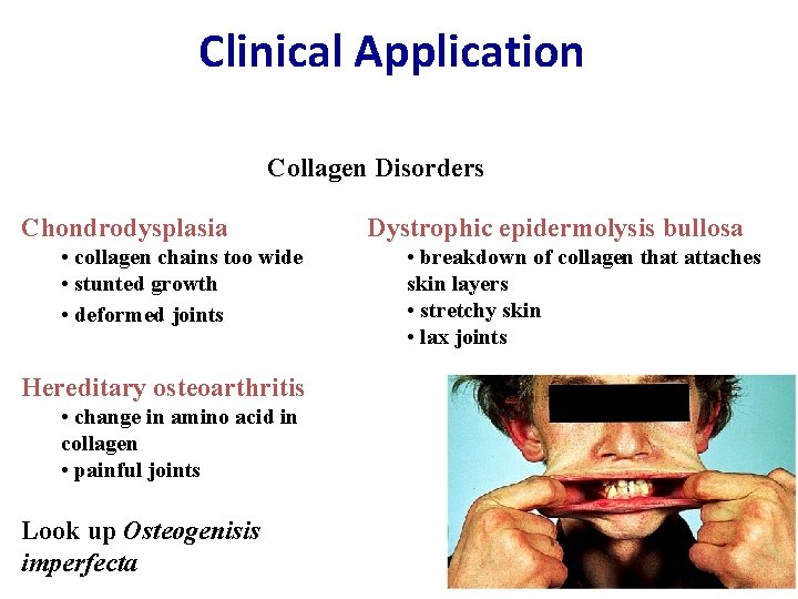 Clinical Application Collagen Disorders Chondrodysplasia • collagen chains too wide • stunted growth •