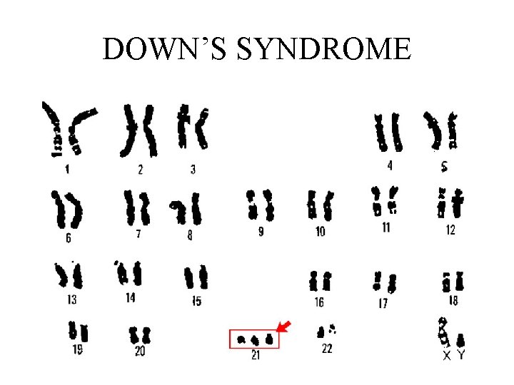 DOWN’S SYNDROME 