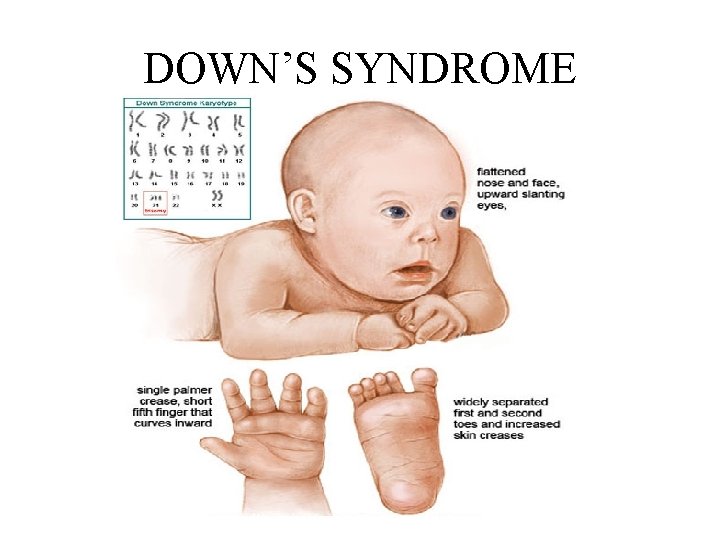 DOWN’S SYNDROME 