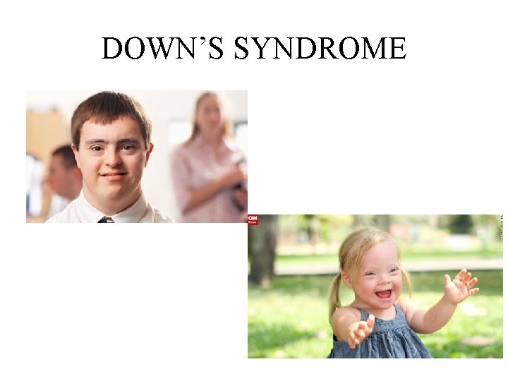 DOWN’S SYNDROME 