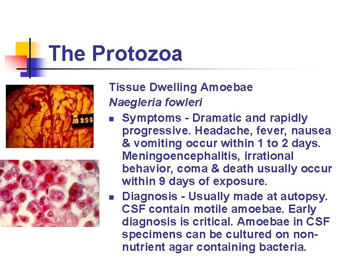 The Protozoa Tissue Dwelling Amoebae Naegleria fowleri n Symptoms - Dramatic and rapidly progressive.