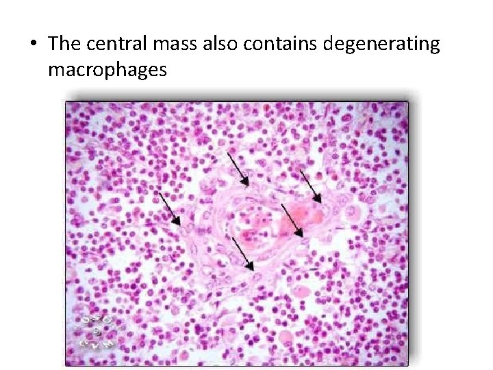  • The central mass also contains degenerating macrophages 
