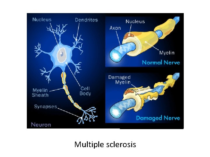 Multiple sclerosis 