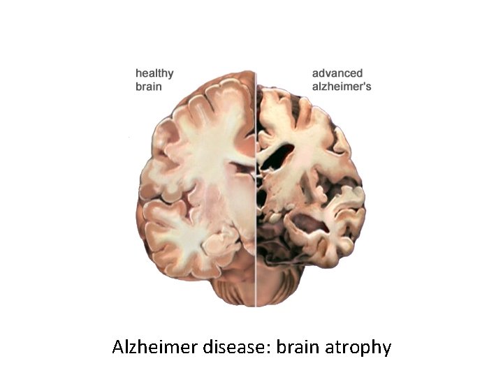 Alzheimer disease: brain atrophy 