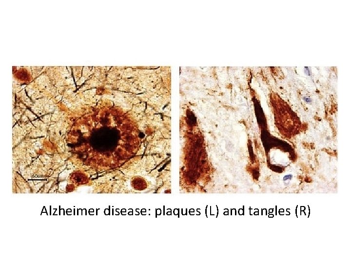 Alzheimer disease: plaques (L) and tangles (R) 