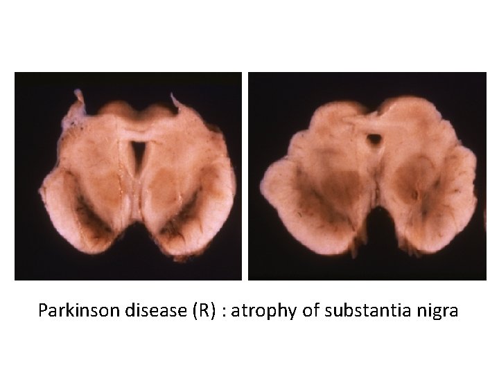 Parkinson disease (R) : atrophy of substantia nigra 