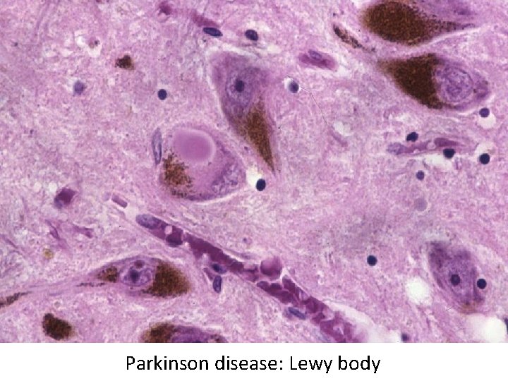 Parkinson disease: Lewy body 