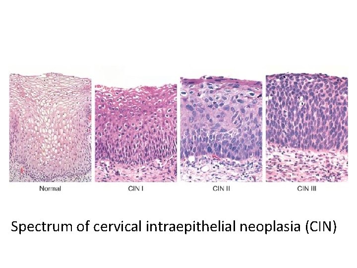 Spectrum of cervical intraepithelial neoplasia (CIN) 