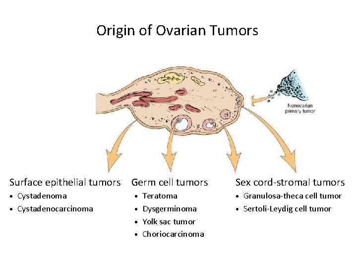 Origin of Ovarian Tumors Surface epithelial tumors Germ cell tumors Sex cord-stromal tumors Cystadenoma