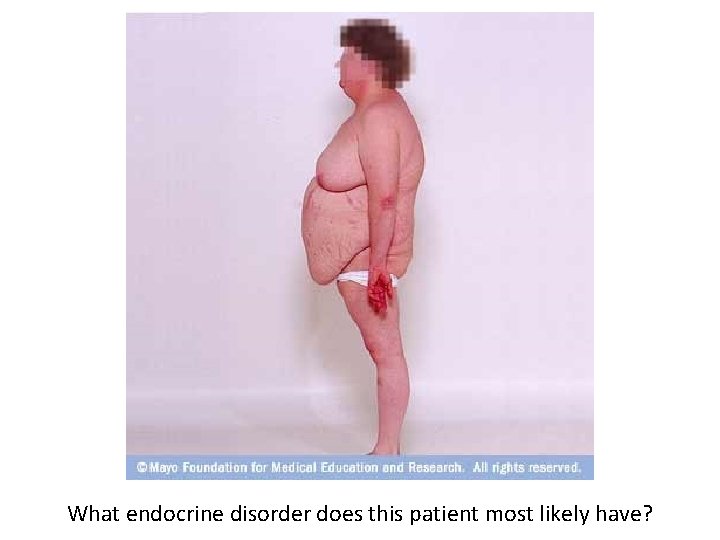 What endocrine disorder does this patient most likely have? 