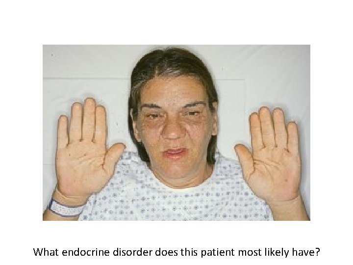 What endocrine disorder does this patient most likely have? 