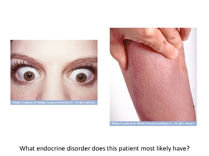 What endocrine disorder does this patient most likely have? 