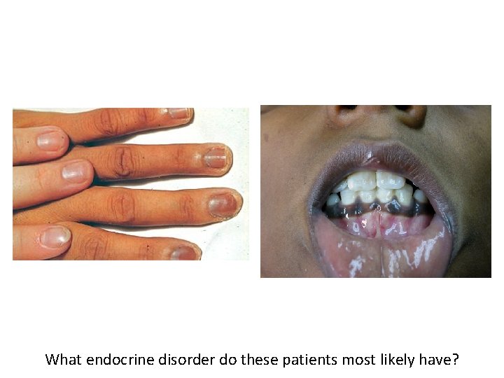 What endocrine disorder do these patients most likely have? 