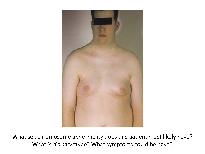 What sex chromosome abnormality does this patient most likely have? What is his karyotype?
