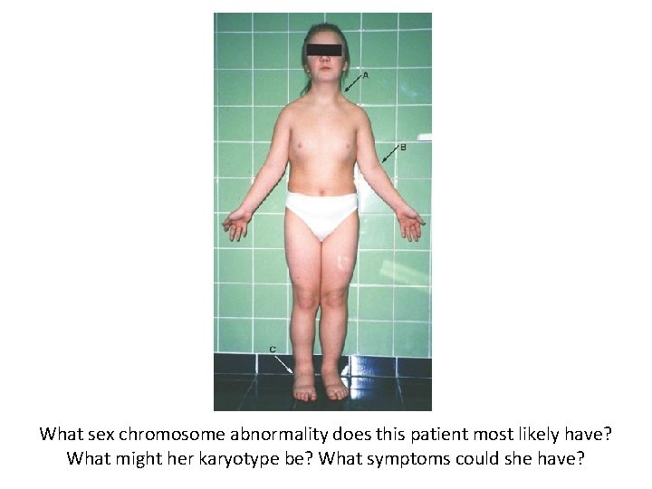 What sex chromosome abnormality does this patient most likely have? What might her karyotype