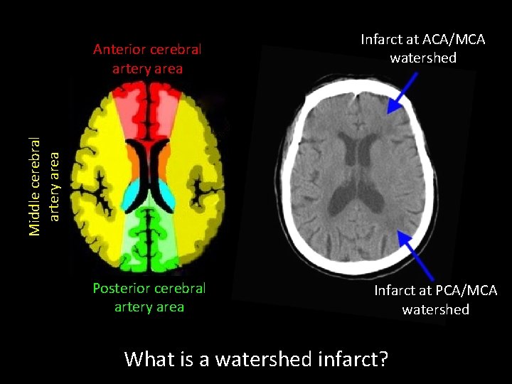 Middle cerebral artery area Anterior cerebral artery area Infarct at ACA/MCA watershed Posterior cerebral