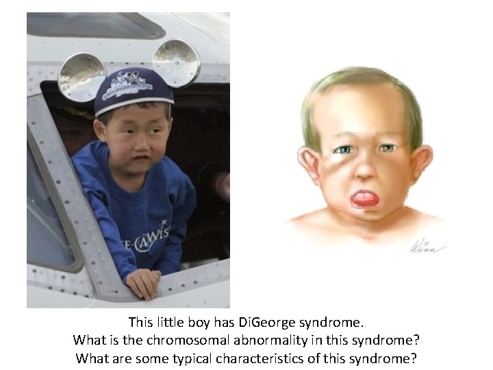 This little boy has Di. George syndrome. What is the chromosomal abnormality in this