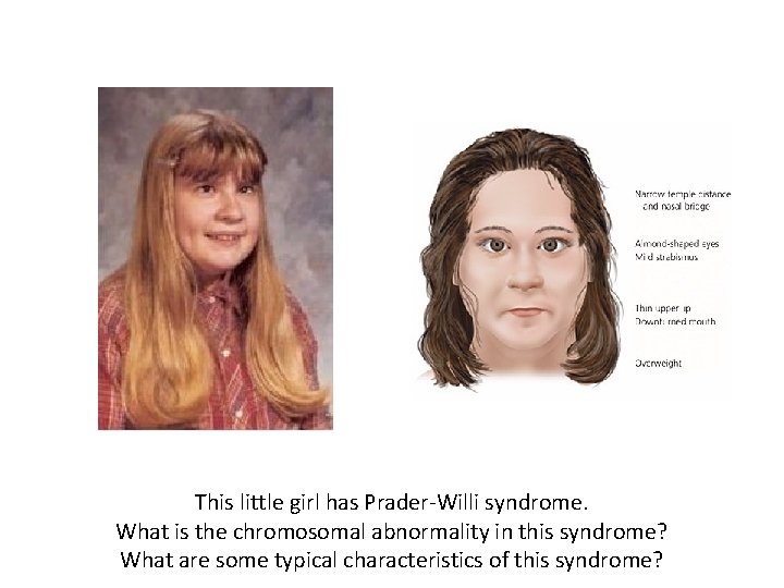 This little girl has Prader-Willi syndrome. What is the chromosomal abnormality in this syndrome?