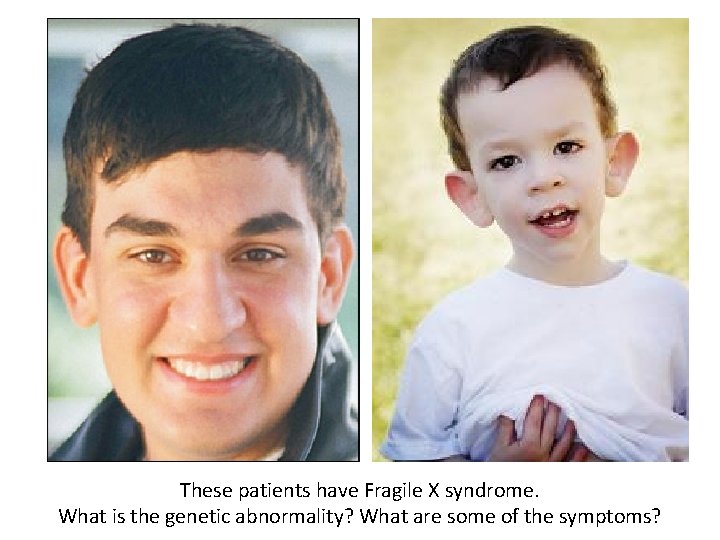 These patients have Fragile X syndrome. What is the genetic abnormality? What are some