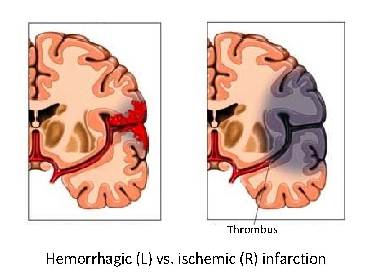 Thrombus Hemorrhagic (L) vs. ischemic (R) infarction 