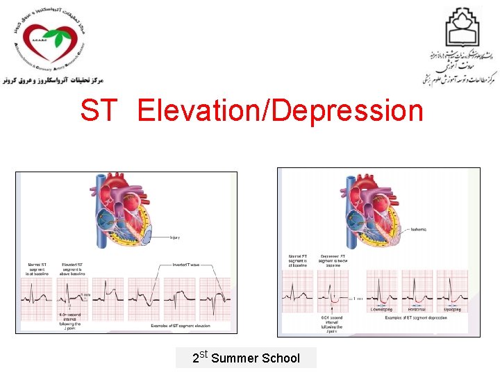 ST Elevation/Depression 2 st Summer School 