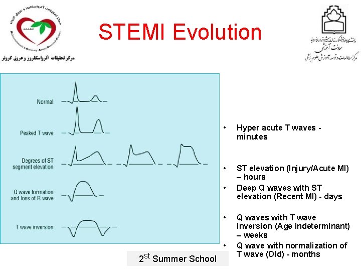 STEMI Evolution • Hyper acute T waves minutes • ST elevation (Injury/Acute MI) –