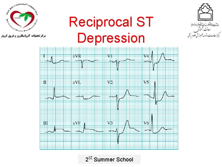 Reciprocal ST Depression 2 st Summer School 