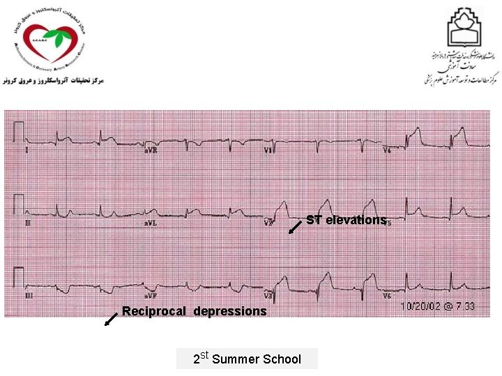 ST elevations Reciprocal depressions 2 st Summer School 